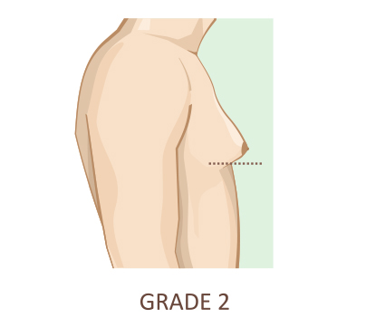 Gynecomastia Surgery Types Procedure Recovery